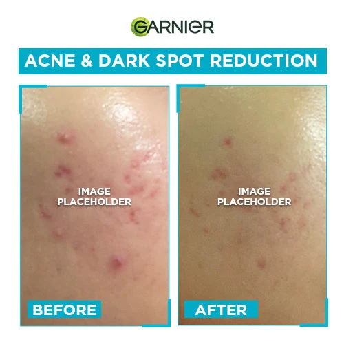 GARNIER BRIGHT COMPLETE ANTI-ACNE BOOSTER SERUM 15ML - Image 5